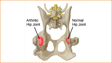 Articolazione artrosica